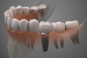 Dental Implant In Your Mouth Graphic