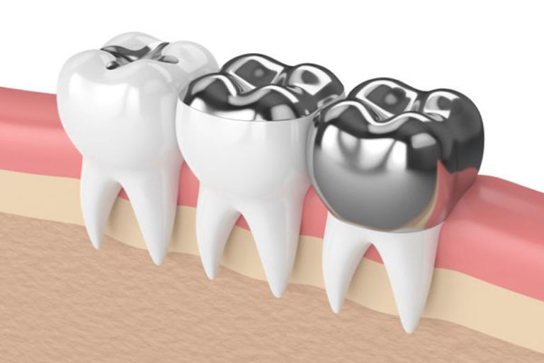 What to Do if Your Implant Crown Breaks Preferred Dental Center