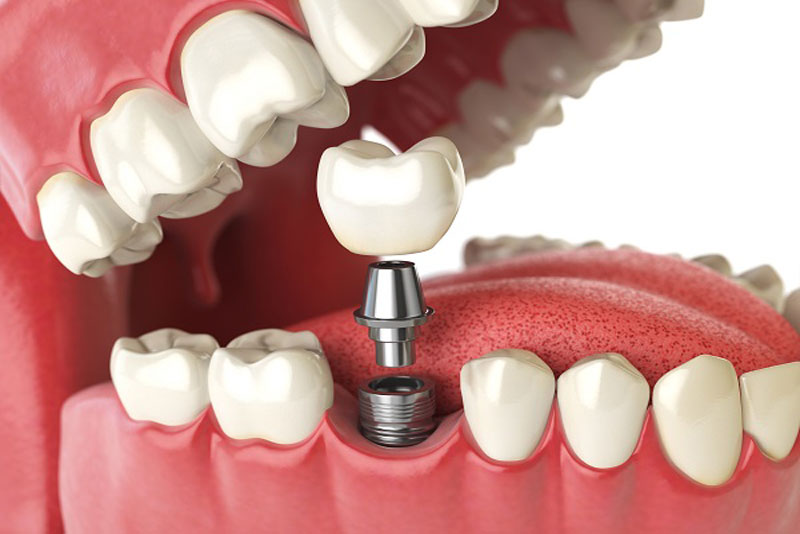 Dental Implant In A Patient's Mouth Graphic