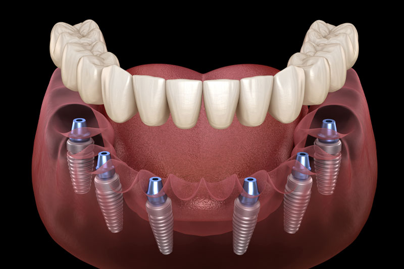 Full Mouth Dental Implants