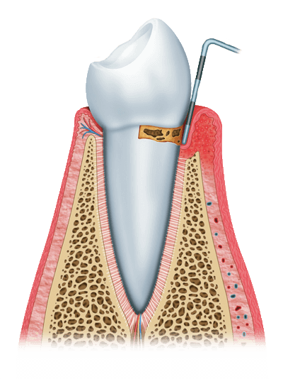 Gingivitis graphic