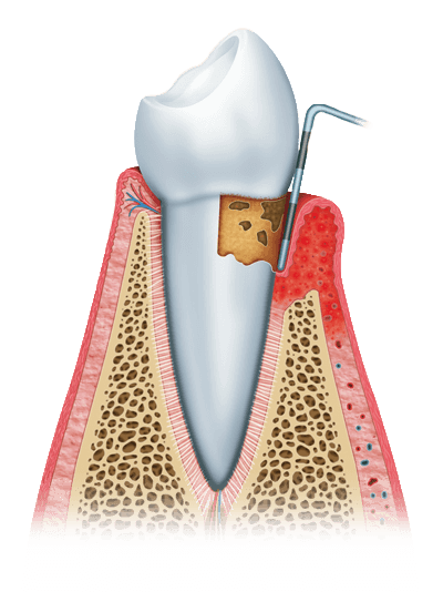 Periodontitis graphic