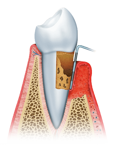 Advanced Periodontitis graphic