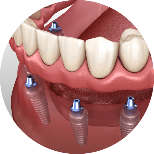 Implant Supported Dentures