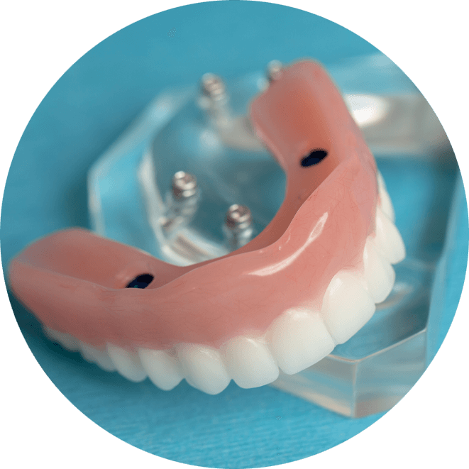 implant supported denture model