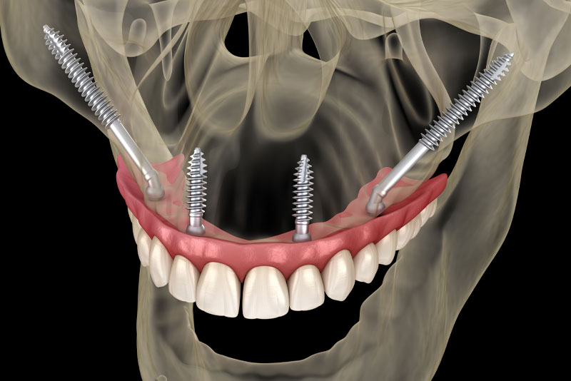zygomatic dental implant model