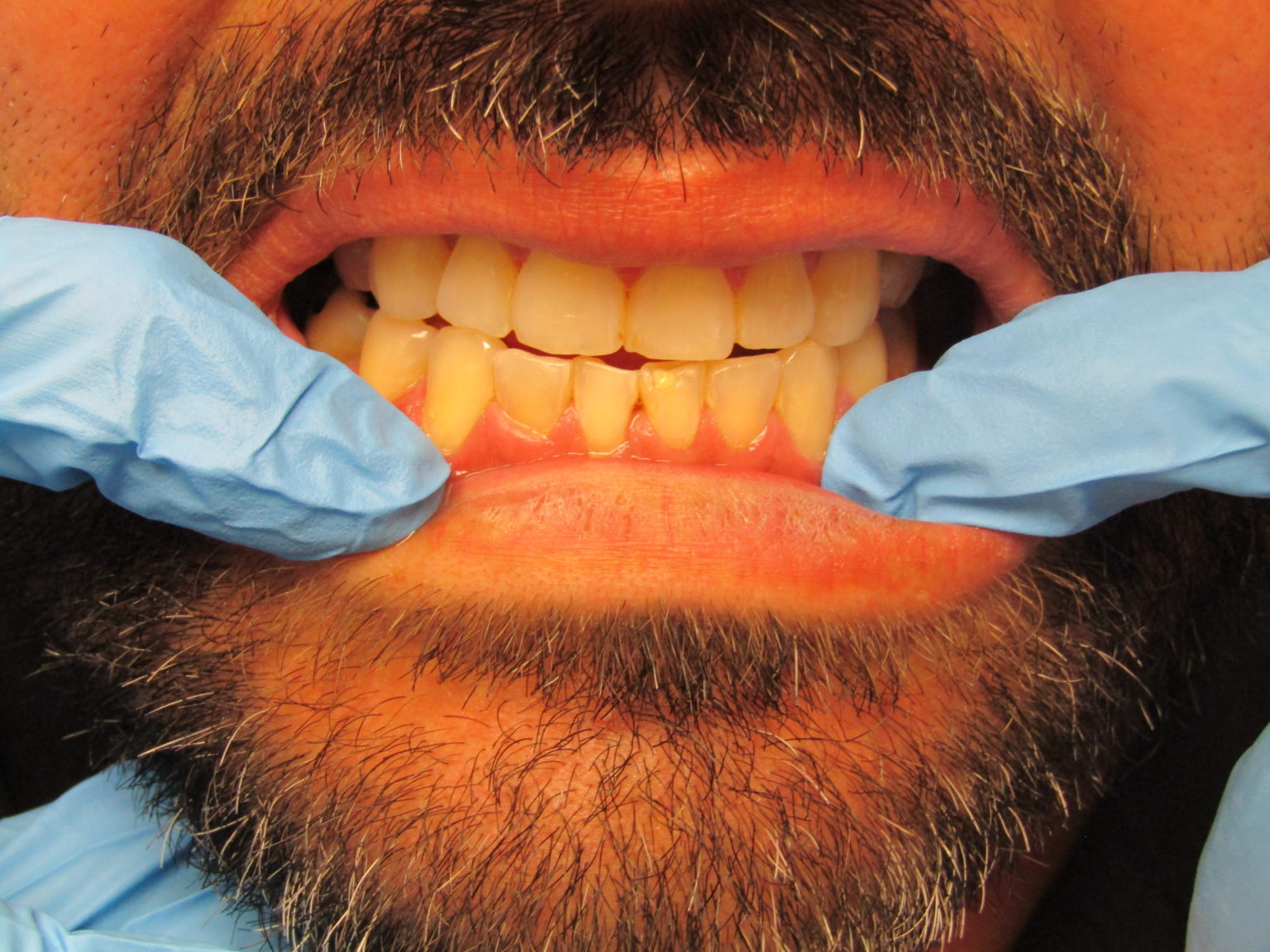 Porcelain Veneers San Antonio, TX Preferred Dental Center