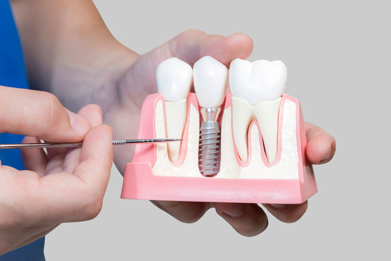 Dental Assistant Showing Off A Dental Implant In A Jawbone Cutaway Model in San Antonio, TX