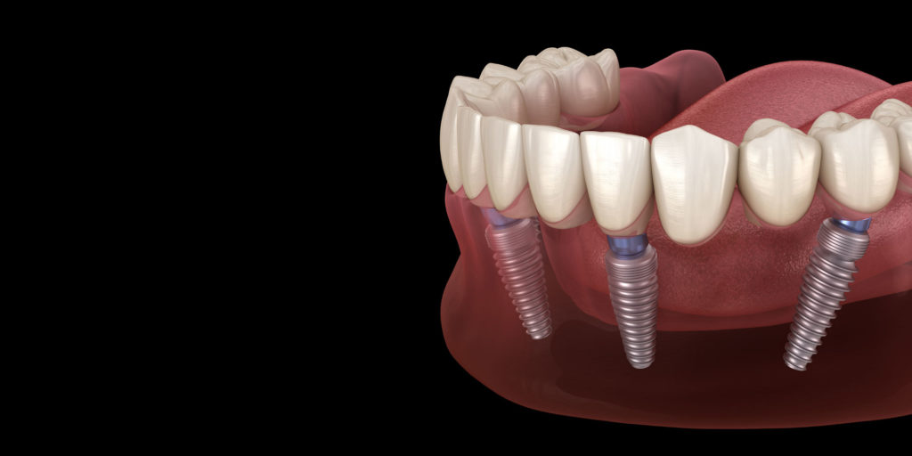 all on 4 dental implants graphics