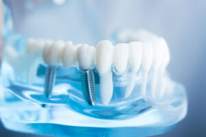 a dental implant model being displayed with 2 implants on each side