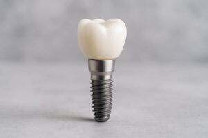 a single dental implant with a full arch going across it