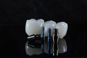 a dental bridge with implants placed under it