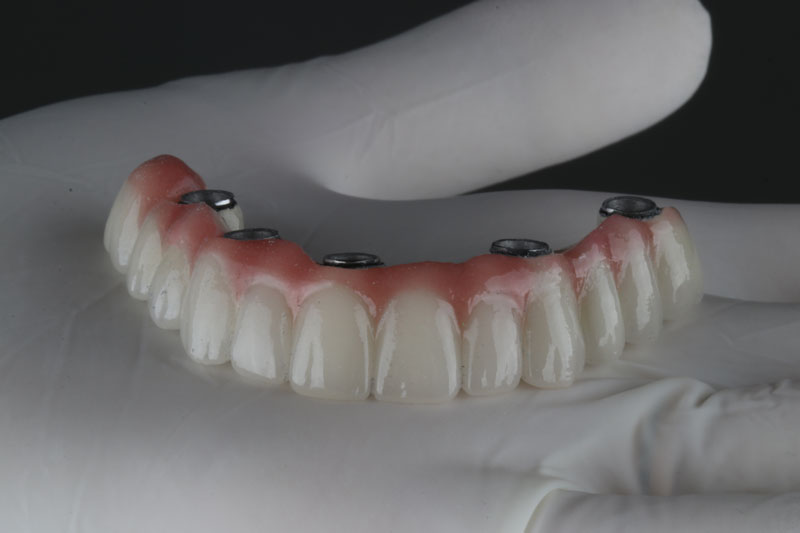 a full arch of teeth with holes for implants to be placed into the mouth