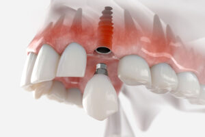 3D illustration of a dental implant in the upper jaw with an abutment and crown placement showing integration with surrounding teeth and gums.
