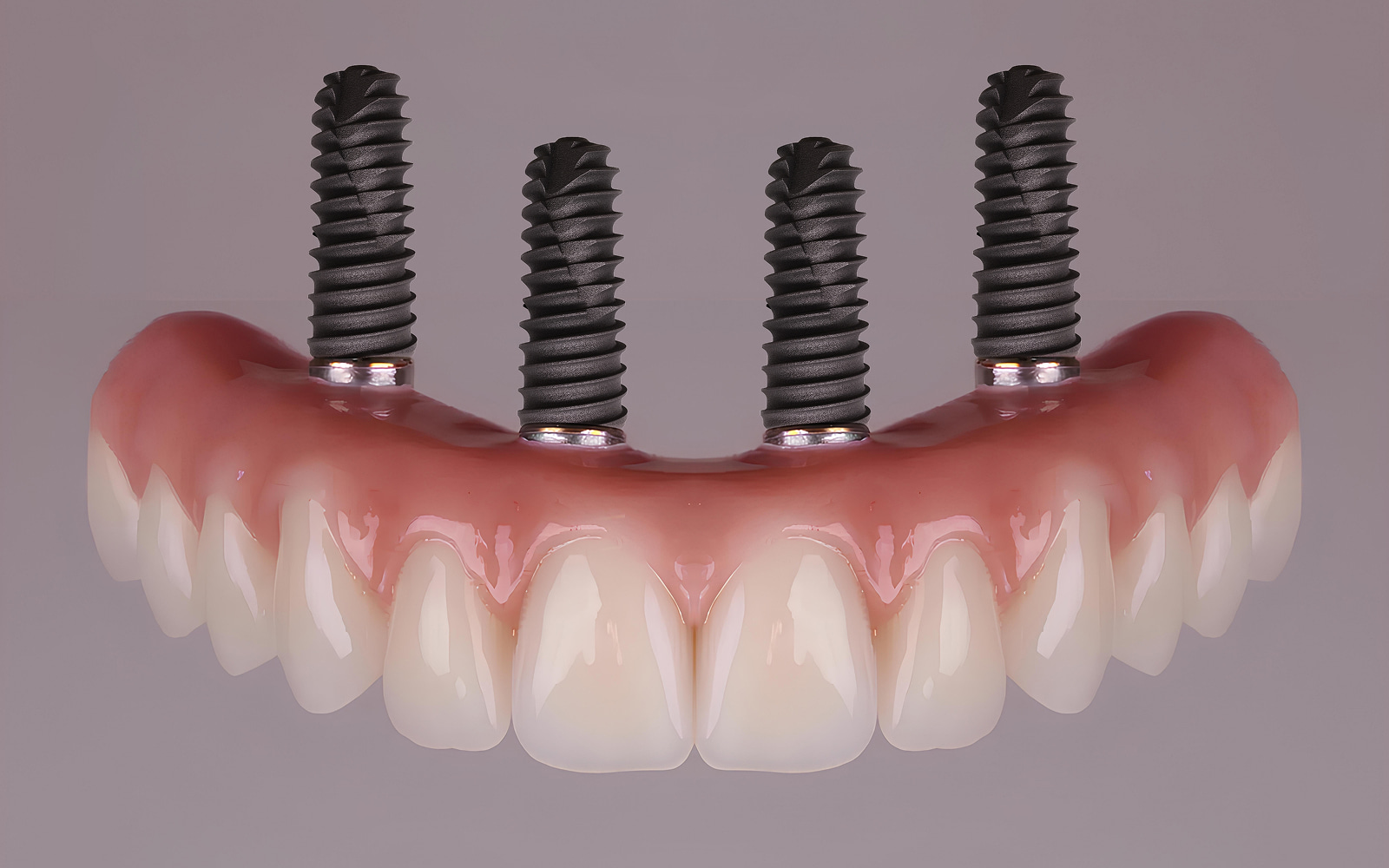 All-on-4 Dental Implants