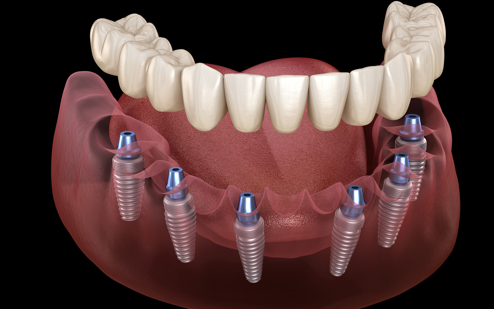 Implant-Supported Dentures