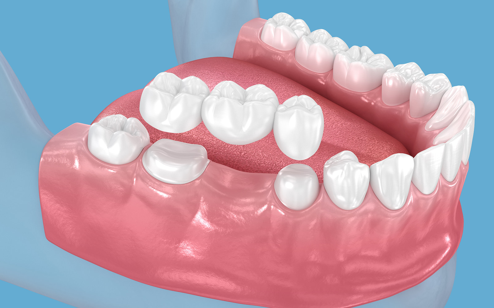 Dental Crowns and Bridges
