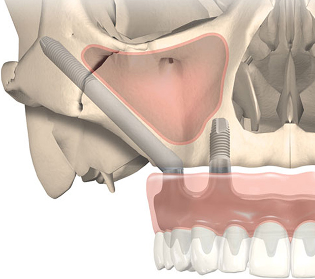 Zygomatic and Pterygoid Implants Preferred Dental Center San Antonio