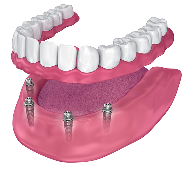 San Antonio All-on-4 Dental Implants