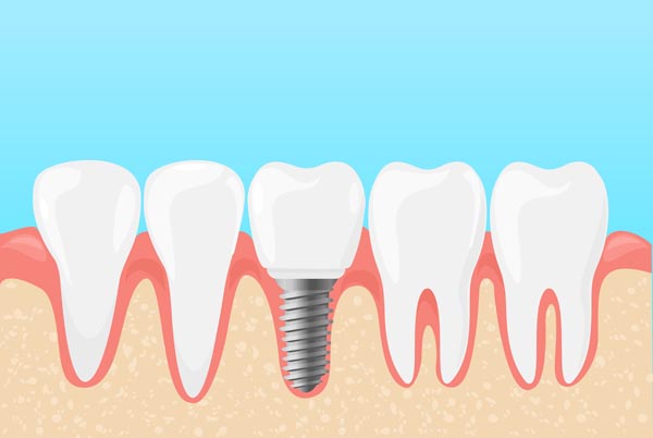 dental implant San Antonio, TX