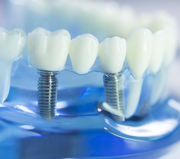 San Antonio Dental Prosthetics