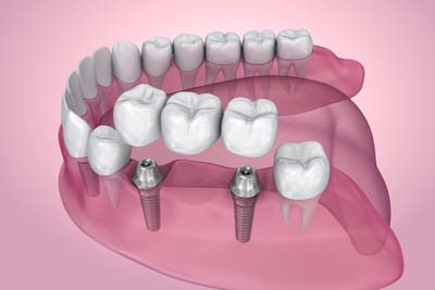 dental implants San Antonio, TX