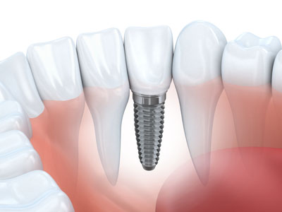 full mouth dental implants San Antonio, TX