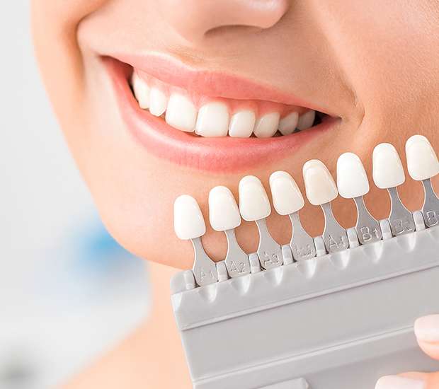 San Antonio Veneers
