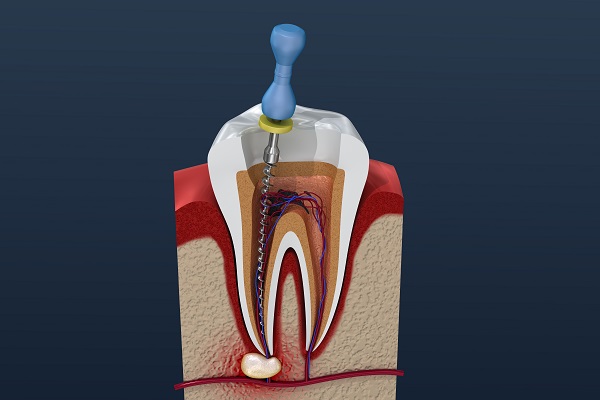 root canal San Antonio, TX