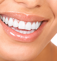 Teeth Whitening Services San Antonio, TX